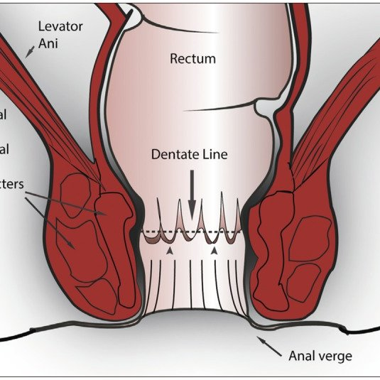 <p>longitudinal tear of the perianal skin distal to the dentate line, often due to increased anal sphincter tone.</p>