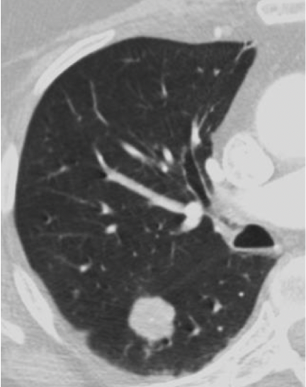 <p>benign or malignant?</p>