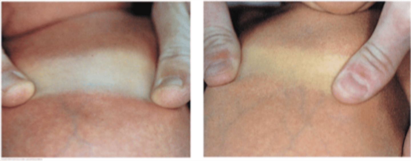 <p>apply pressure to skin to press out normal color</p><p>yellow blanching = jaundice</p>
