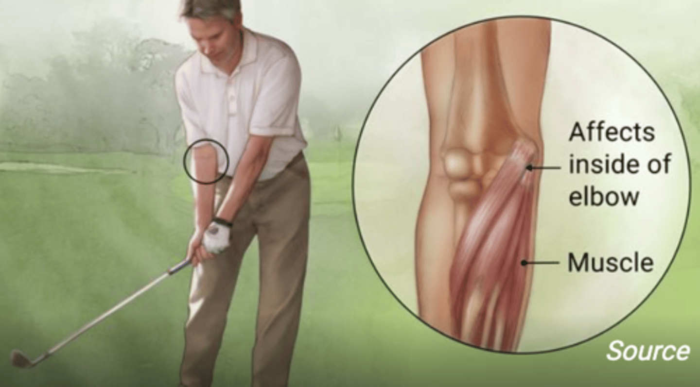 <p>• Pain with wrist flexion.</p><p>• Pain upon palpation of the medial epicondyle.</p><p>• Pain that may radiate down the forearm.</p><p>• Pain radiation may be caused by ulnar nerve compression.</p>