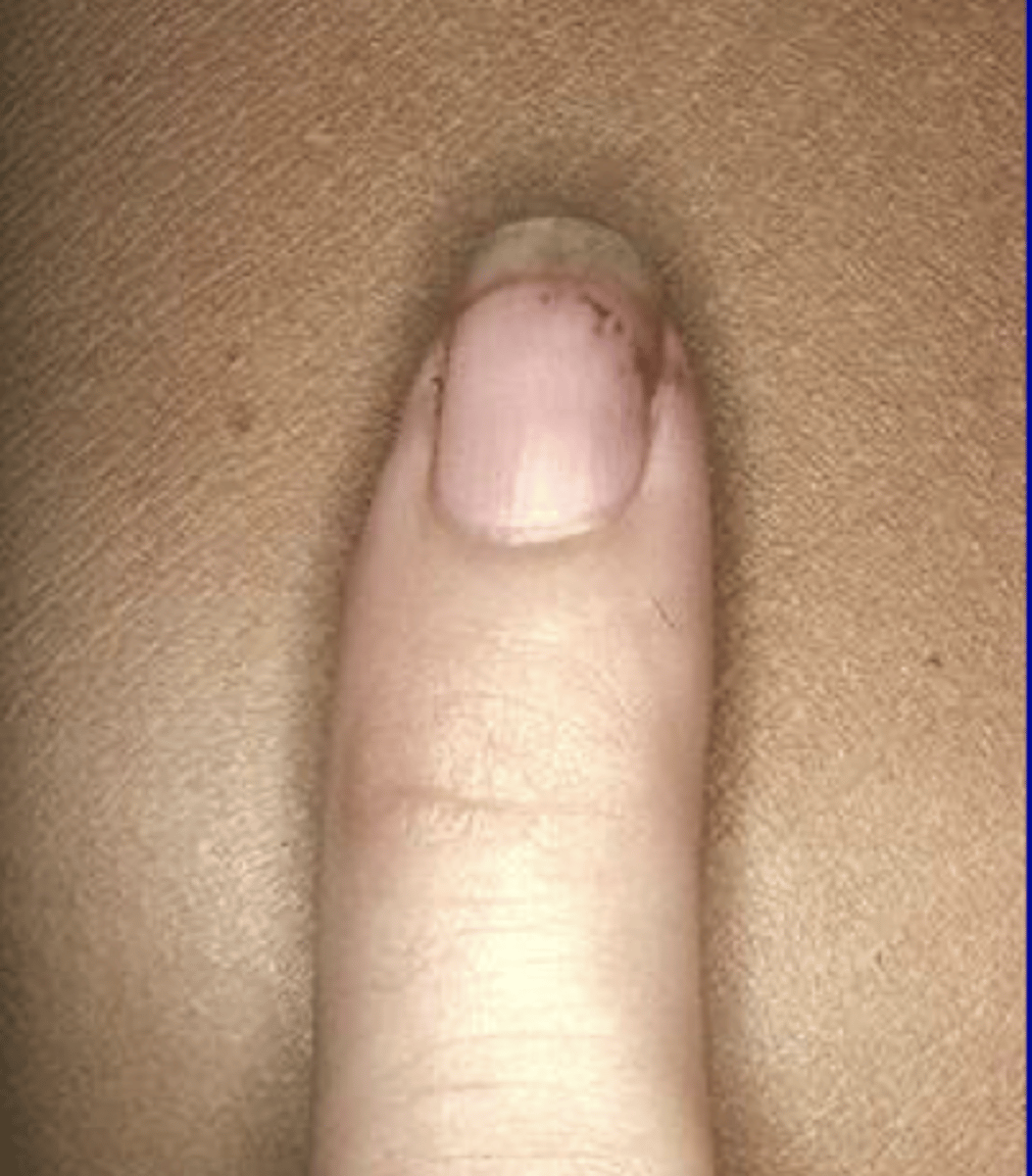 <p>brown streaks under nails (more significant when seen in proximal nail bed)</p>