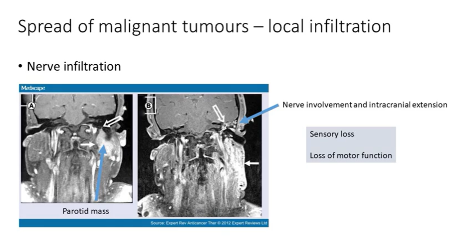 <ul><li><p>extension of this mass into the facial nerve - cranial fossa </p></li><li><p>symptoms may include sensory loss or loss of motor function </p></li></ul><p></p>
