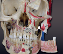 <p>cavity within a bone</p>