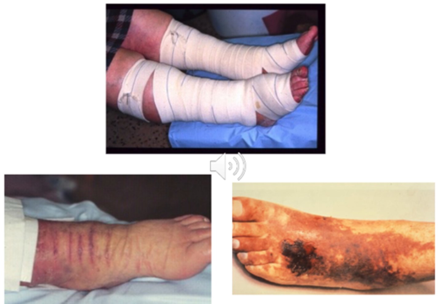 <p>-DM</p><p>-Peripheral arterial disease</p><p>-Acute cellulitis/infection</p><p>-Neuropathy</p><p>-Acute heart failure</p><p>-Low ejection fraction</p><p>-Fragile skin</p>