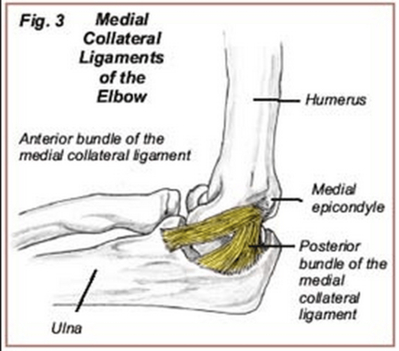 <p>- overuse injury of the elbow</p><p>- due to repetitive flexion (forehand shots) or can be idiopathic</p><p>- causes pain at the medial epicondyle</p>