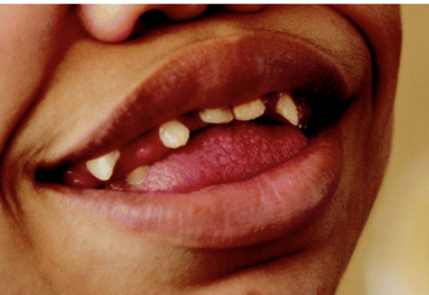 <p>-macroglossia</p><p>-gingival hyperplasia, esp anterior regions</p>