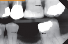 <p>caries or cervical burnout </p>