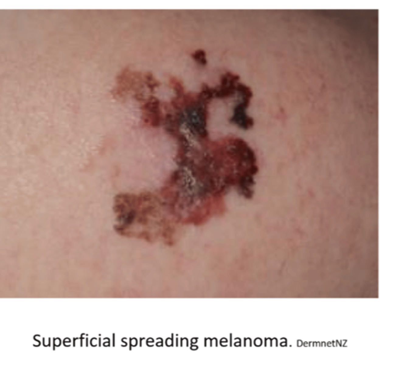 <p>small, slightly evelated and superficial but can invade deeper tissues later</p>