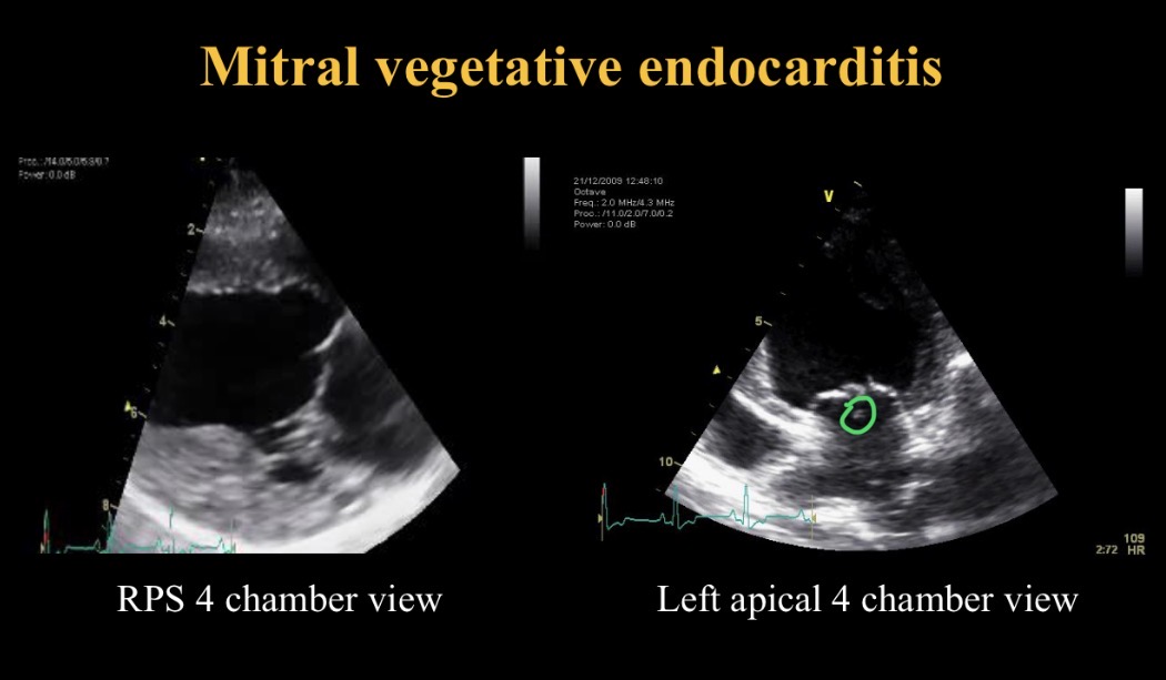 <p>Endocarditis appearance </p>