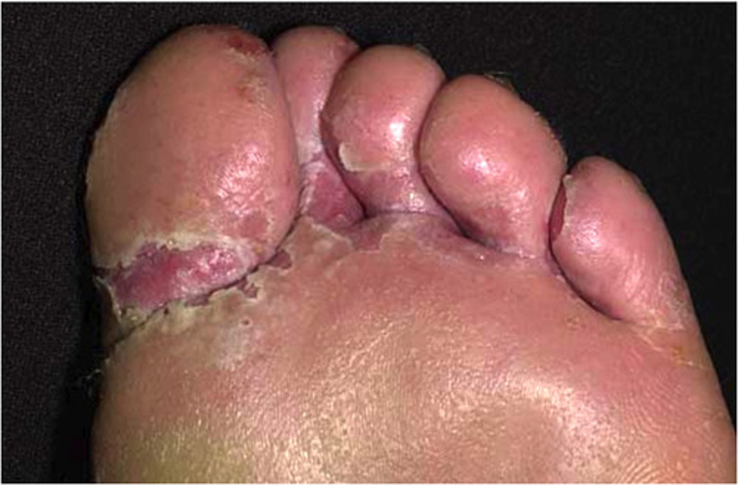 <p>contagious fungal infection in the outer skin layer that leads to skin eruptions which usually form small blisters between toes and sometimes fingers, followed by cracking, peeling and scaling</p>
