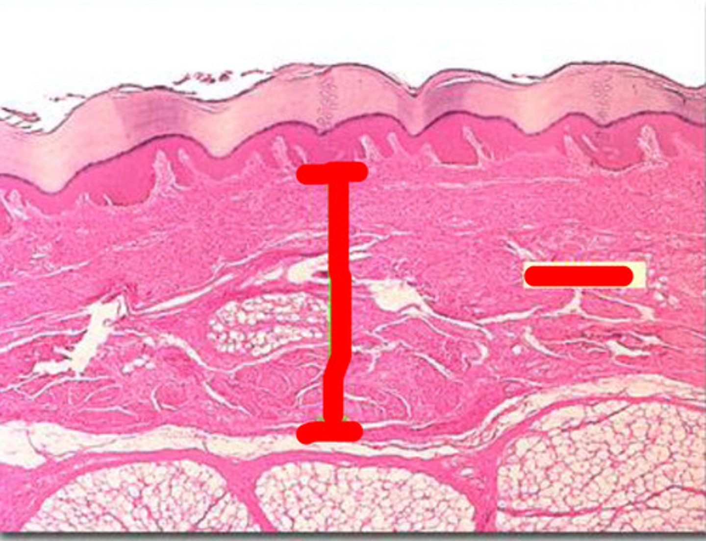 <p>Covers the palms of the hands and soles of the feet</p><p>Has 5 layers of keratinocytes</p>