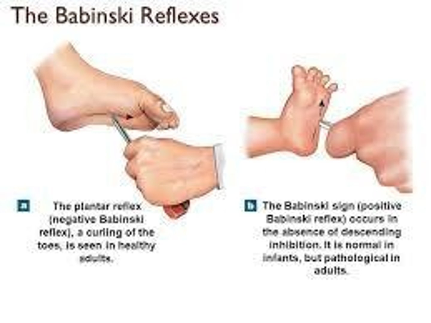 <p>Moro reflex, tonic neck reflex, rooting reflex, sucking reflex, Babinski reflex, grasp reflex, and stepping reflex.</p>