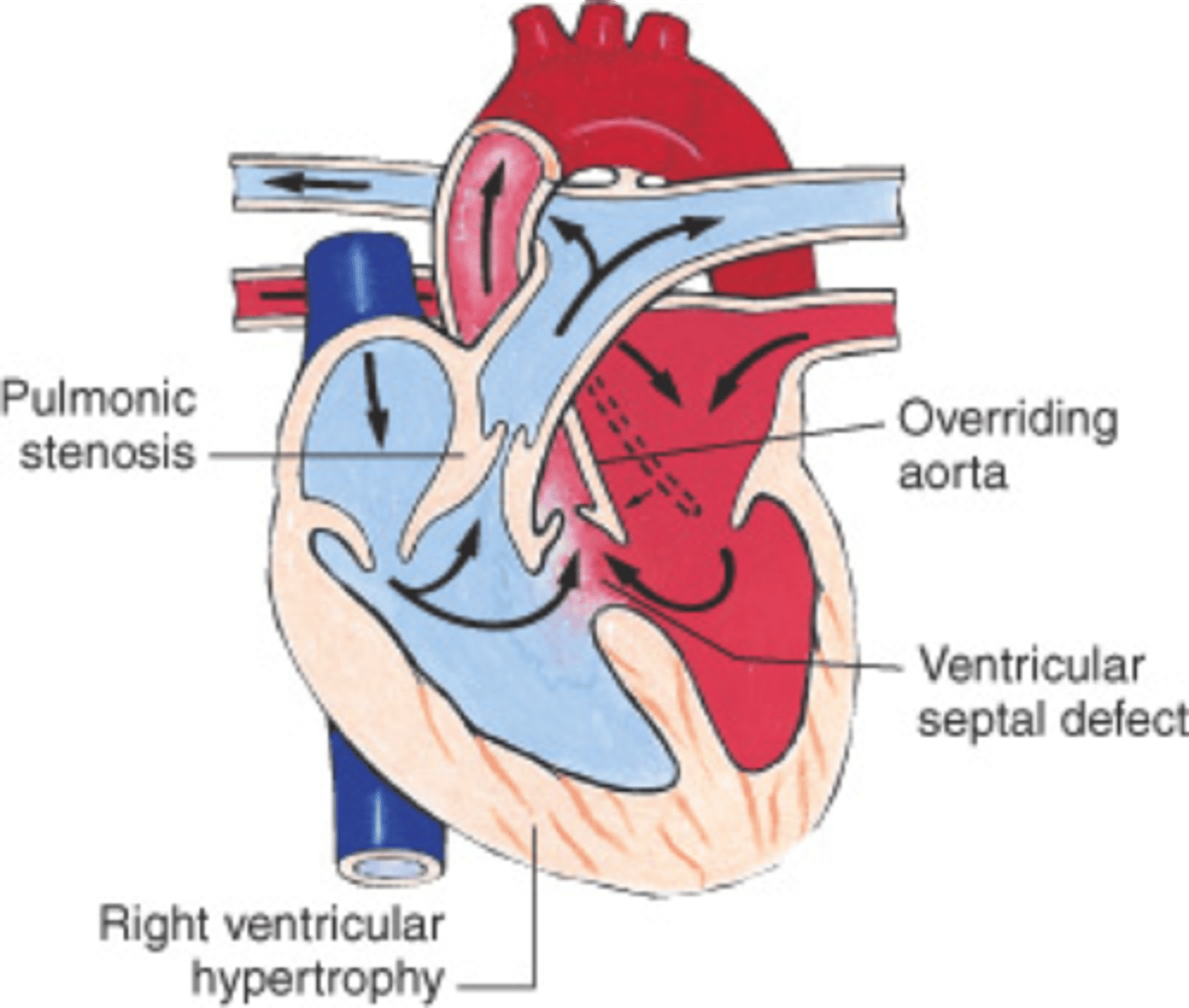 <p>Cyanotic congenital heart defect characterized by 4 main defects: a VSD, overriding aorta, RV hypertrophy, &amp; pulmonary stenosis</p>