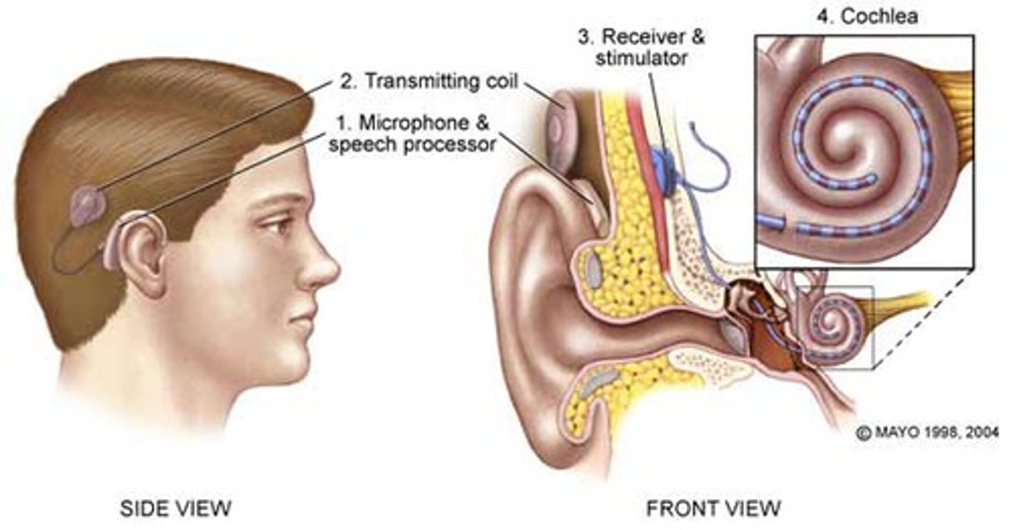 <p>An electrical prosthetic device that enables individuals with sensorineural hearing loss to recognize some sounds and that consists of an external microphone and speech processor that receive and convert sound waves into electrical signals which are transmitted to one or more electrodes implanted in the cochlea where they stimulate the auditory nerve.</p>