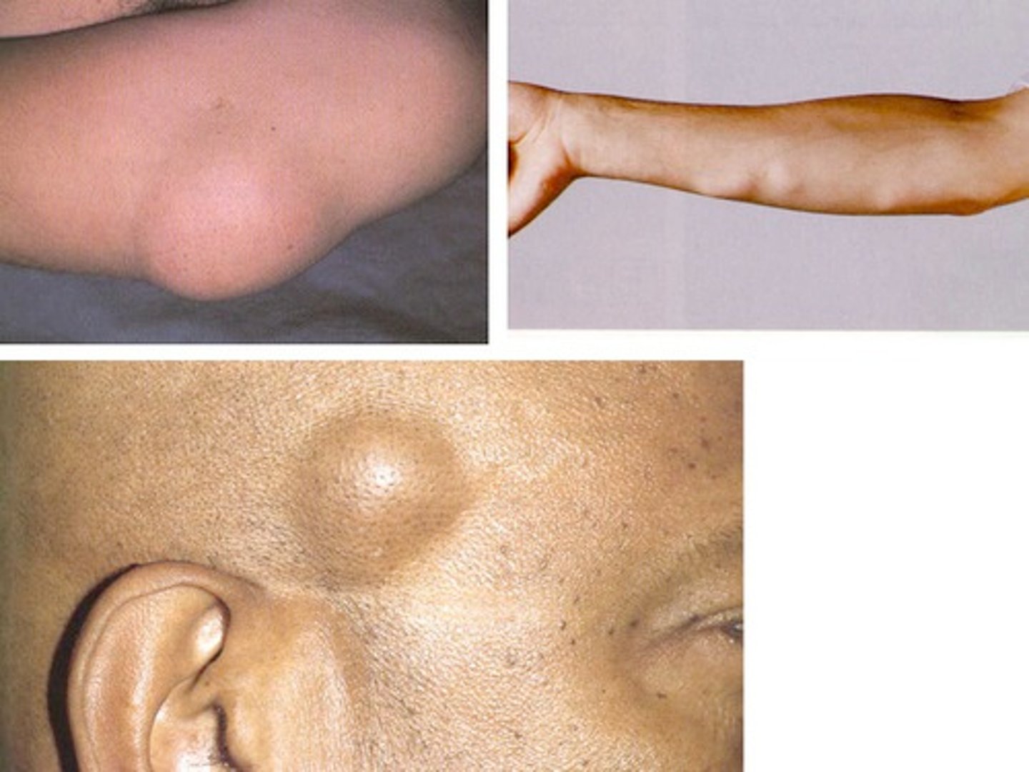 <p>Nodule (primary lesion)</p>