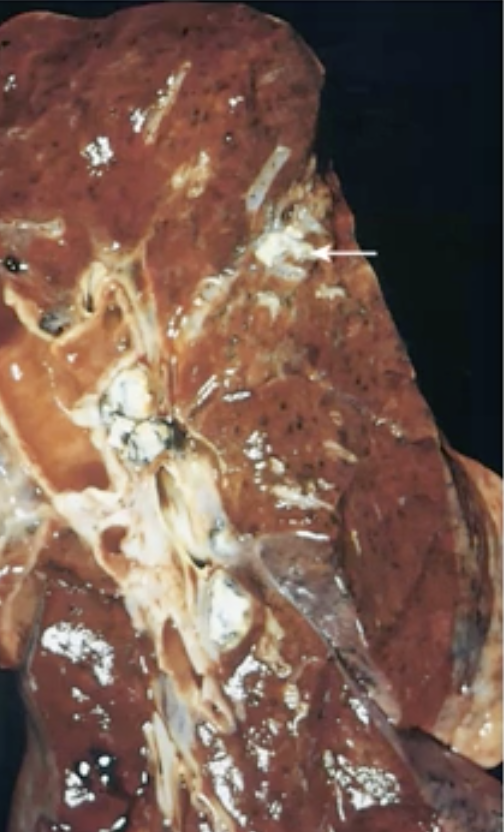 <ul><li><p>Infection of the lung caused by mycobacteria</p></li><li><p>the first infection is not severe but results in remnants in the lung</p></li></ul>