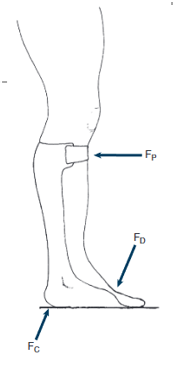 <p>What moment is this 3-point pressure system creating at the ankle? What influence will this have on the knee?</p>