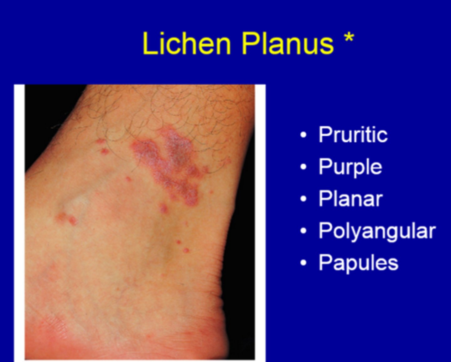 <p>Purple, Polygonal, Planar, Pruritic, Papules (with Wickham Striae)</p>