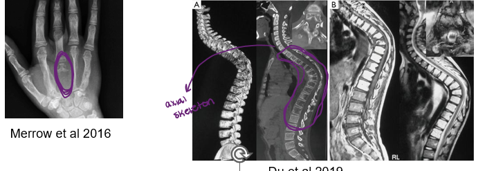 <p><span style="font-family: Arial">Progressive bone loss (osteolysis)</span></p><p><span style="font-family: Arial">Commonly affected areas: ribs, spine, pelvis, skull, collarbone (clavicle), and jaw</span></p><p><span style="font-family: Arial">Symptoms: pain and swelling, disfigurement and functional disability of affected areas. Severity varies.</span></p><p></p><p><span style="font-family: Arial">Cause unknown</span></p>