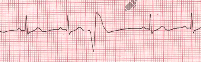 <ul><li><p>an ectopic focus causes an impulse from one of the ventricles</p></li><li><p>Occurs early before the SA node actually fires </p></li><li><p>Wide QRS without a p wave </p></li></ul>