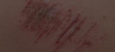 <p>what kind of wound is this</p>