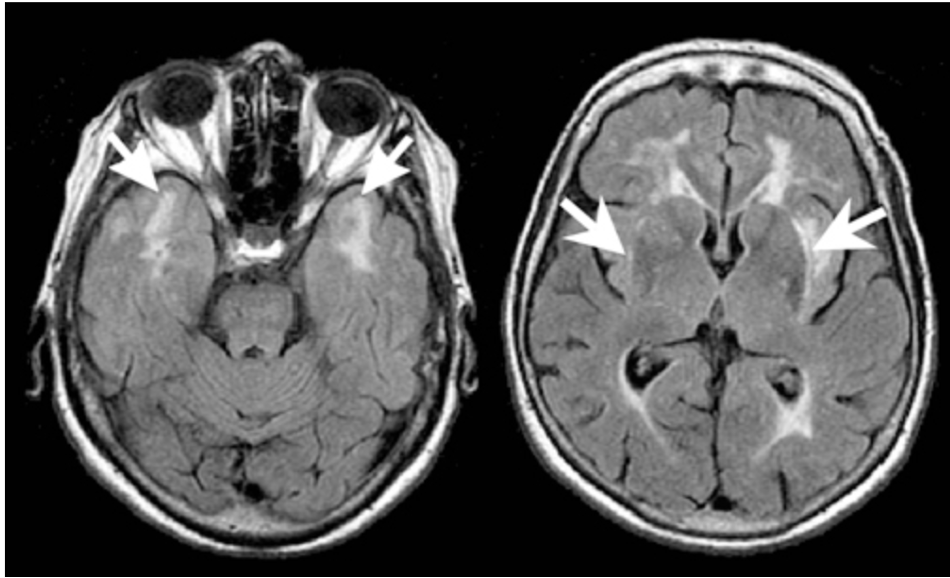 <p>Small, circumscribed regions isointense to CSF on T1 &amp; T2 weighted images</p><p>Less well demarcated T2 hyperdensities/T1 hypodensities clearly distinct from CSF</p>