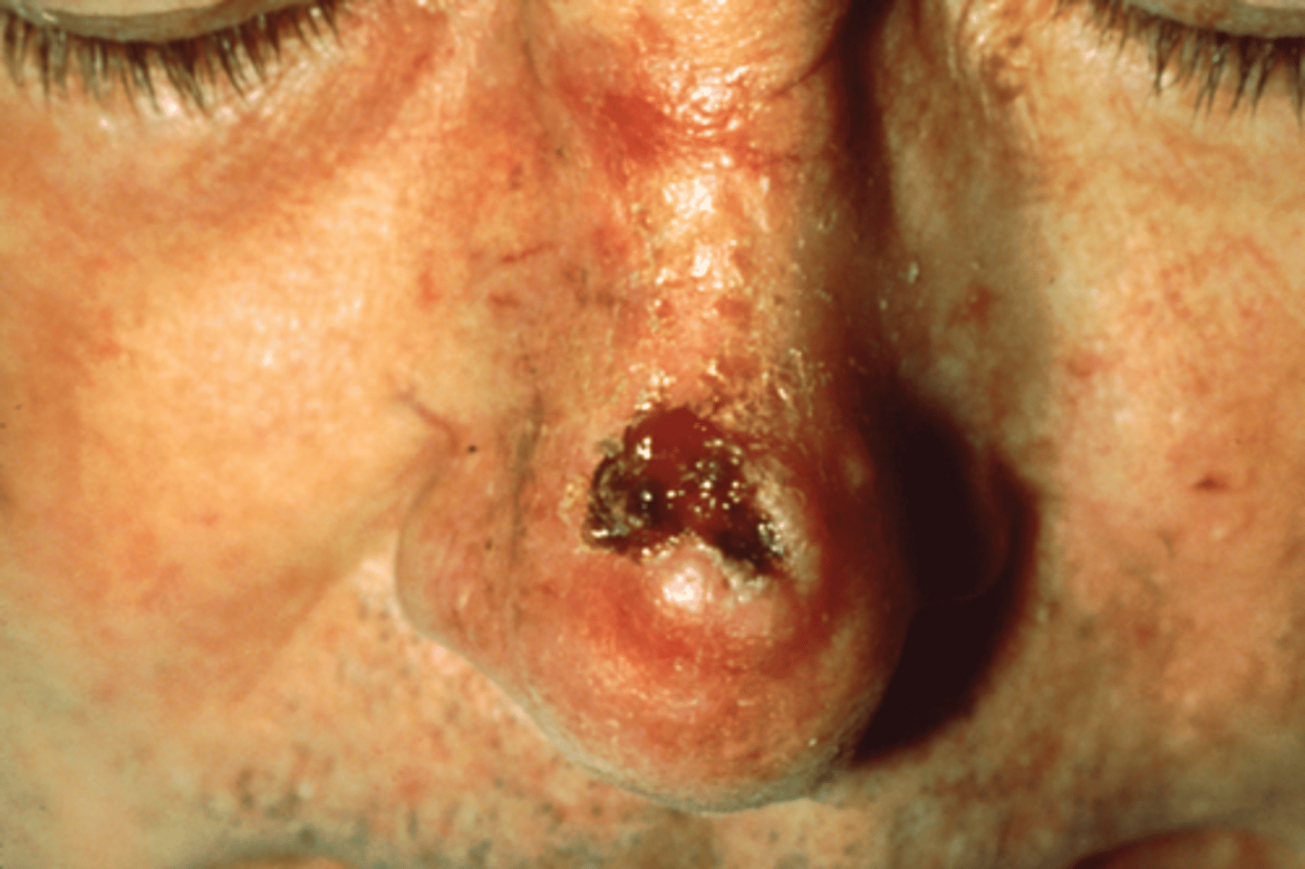 <p>Effects the keratinocytes of the stratum spinosa and presents as lesions; Presents here as a lesion on an individual's nose; Second most common skin cancer</p>