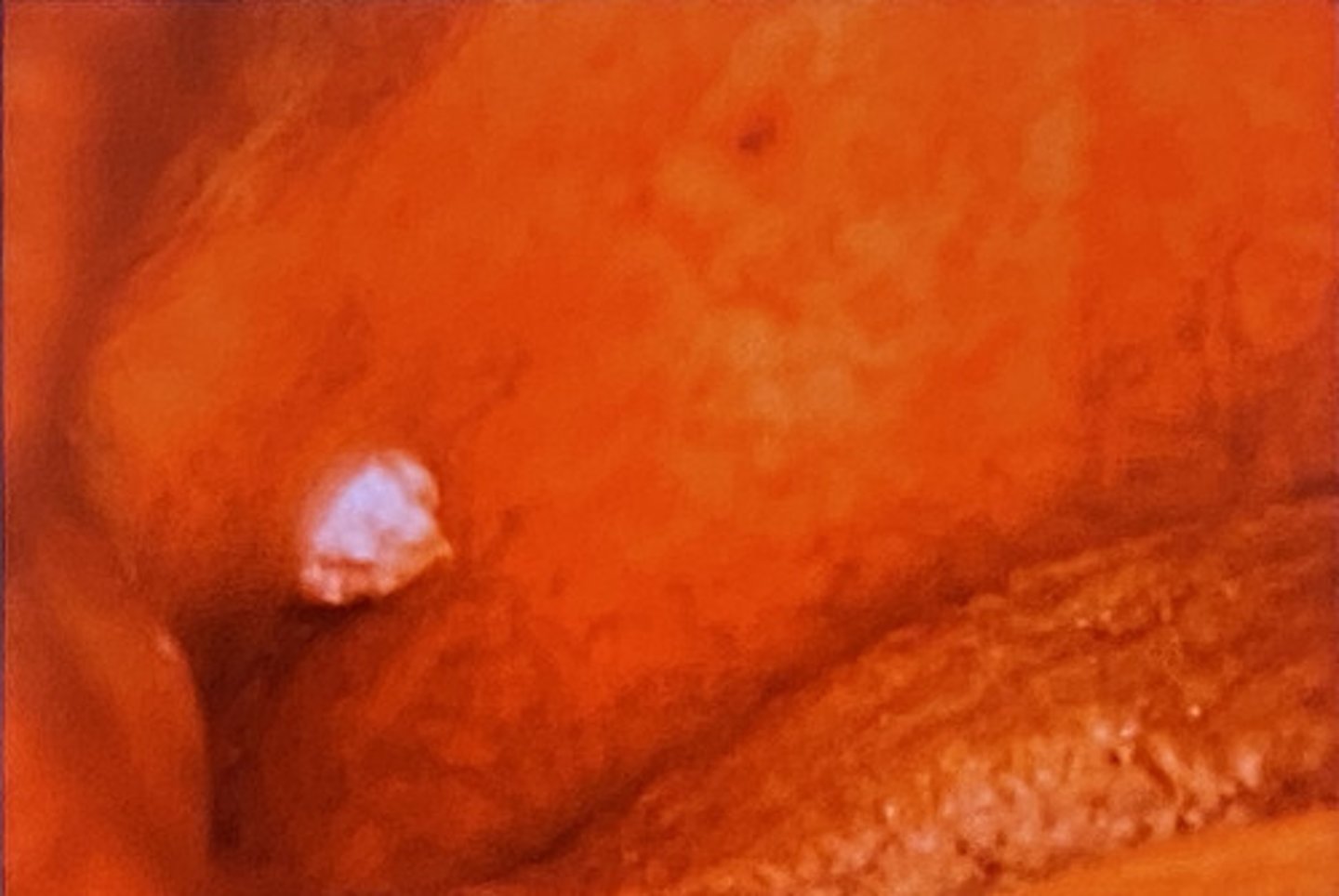 <p>What is your differential for the lesion pictured?</p>