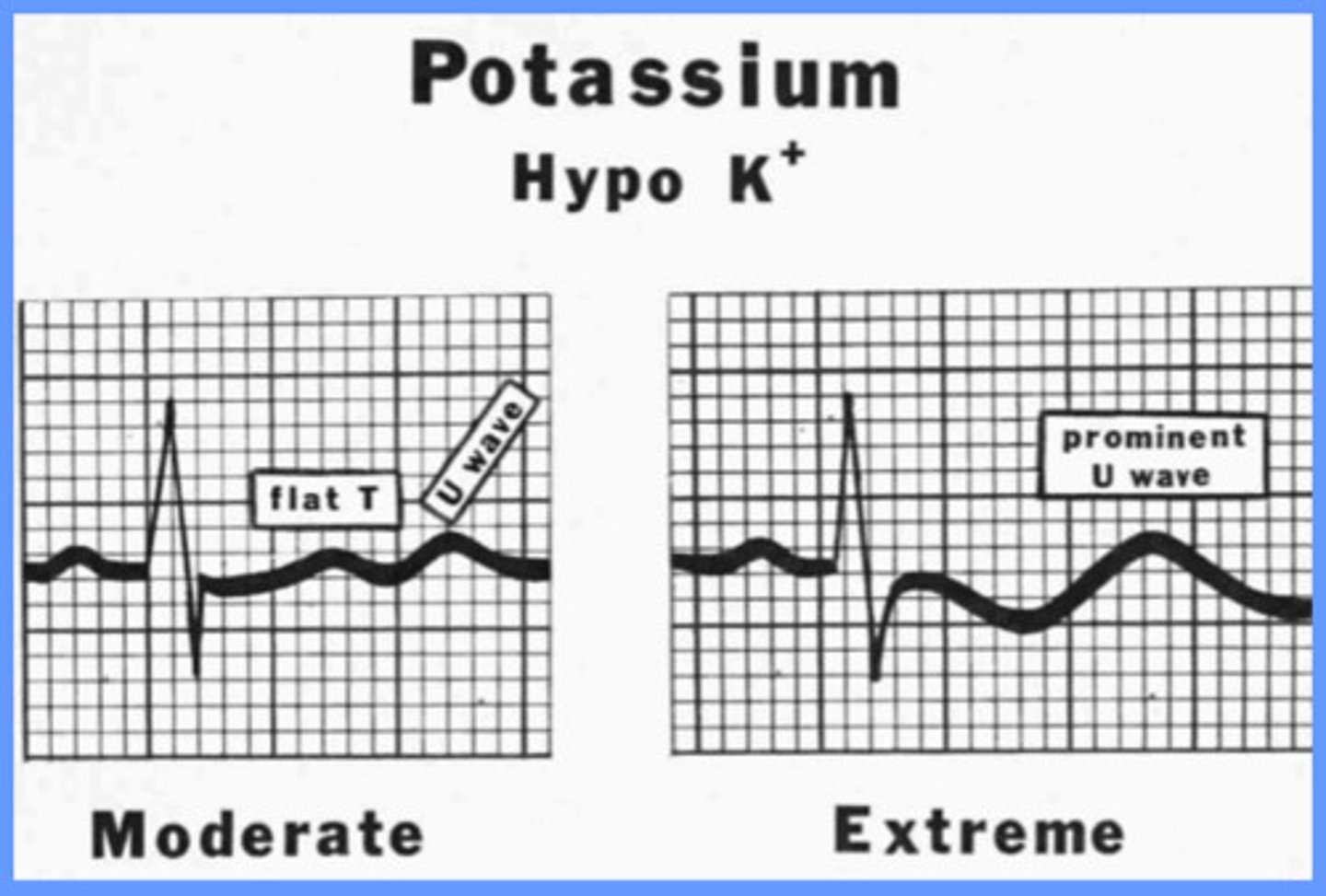 <p>what is the EKG change associated with hypokalemia?</p>