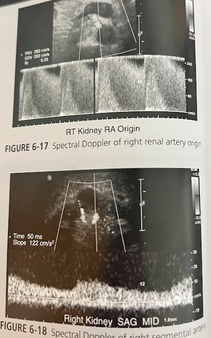 <p>A 62 year old man w/a hx of hypertension and increased BUN and creatinine presents for a renal sonogram. He has a 40-pack per year of tobacco use and c/o pain in his buttocks with walking. Sonographically there is no signs of stone, cysts, masses, or hydro. The rt kidney measures 8cm in length and the lt measures 12cm in length. Doppler eval. reveals a velocity too high to measure accurately at the origin of the rt renal artery. There is a lengthened systolic peak in the rt intrarenal segmental arteries. What is the likely diagnosis?</p>