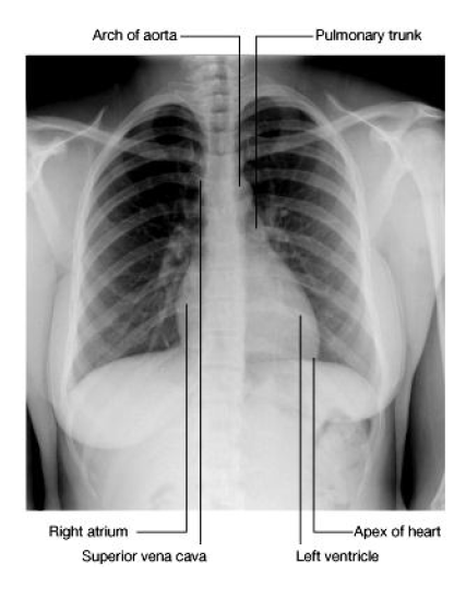 RA, SVC; Aa, PT, LA, LV