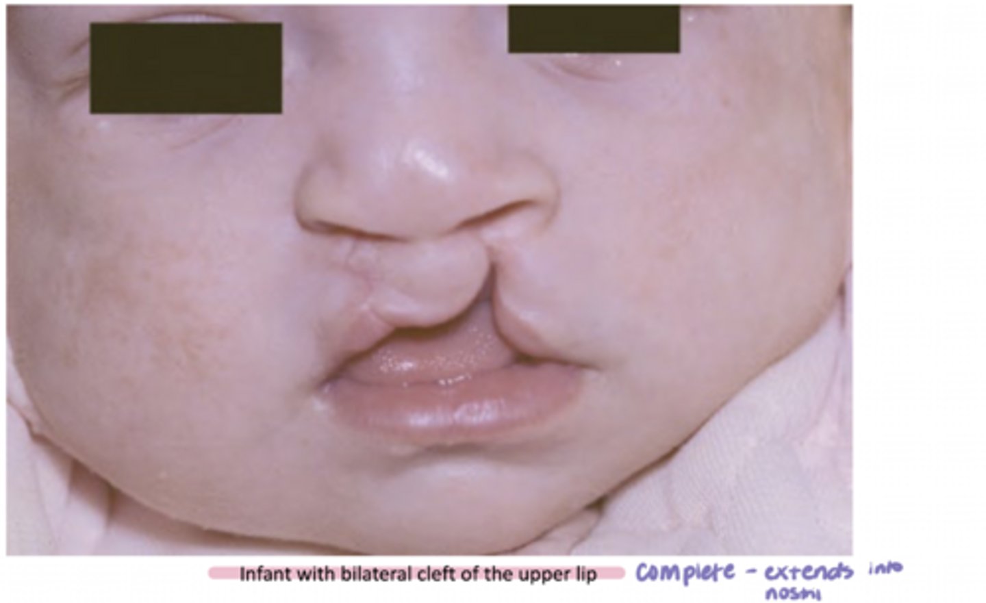 <p>nostril; lateral incisor and cuspid (canine)</p><p>- also, teeth are normally missing (congenitally)</p>
