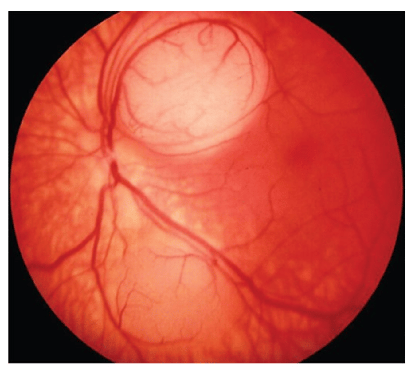 <p><u>Etio</u>: most common eye <strong><mark data-color="#f7ff00" style="background-color: #f7ff00; color: inherit">tumor</mark></strong> in children, 90% present before 5 yo, bilateral usually &lt;1 yo, FHx: <strong>genetic abnormality</strong></p><p><u>S&amp;S</u>: <strong><mark data-color="#e4ff00" style="background-color: #e4ff00; color: inherit">leukocoria</mark>, strabismus</strong>, retinal mass, genetic abnormality of RB1 tumor suppressor gene, may see neurological signs</p><p><u>Testing</u>: CT shows intraocular tumor</p><p><u>Tx</u>: refer to children’s tertiary cancer center</p>