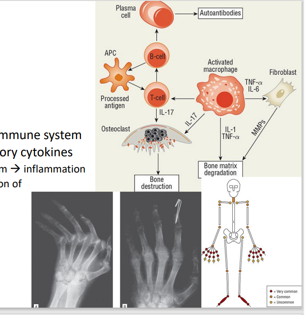 <p>Rheumatoid Arhtritis</p>