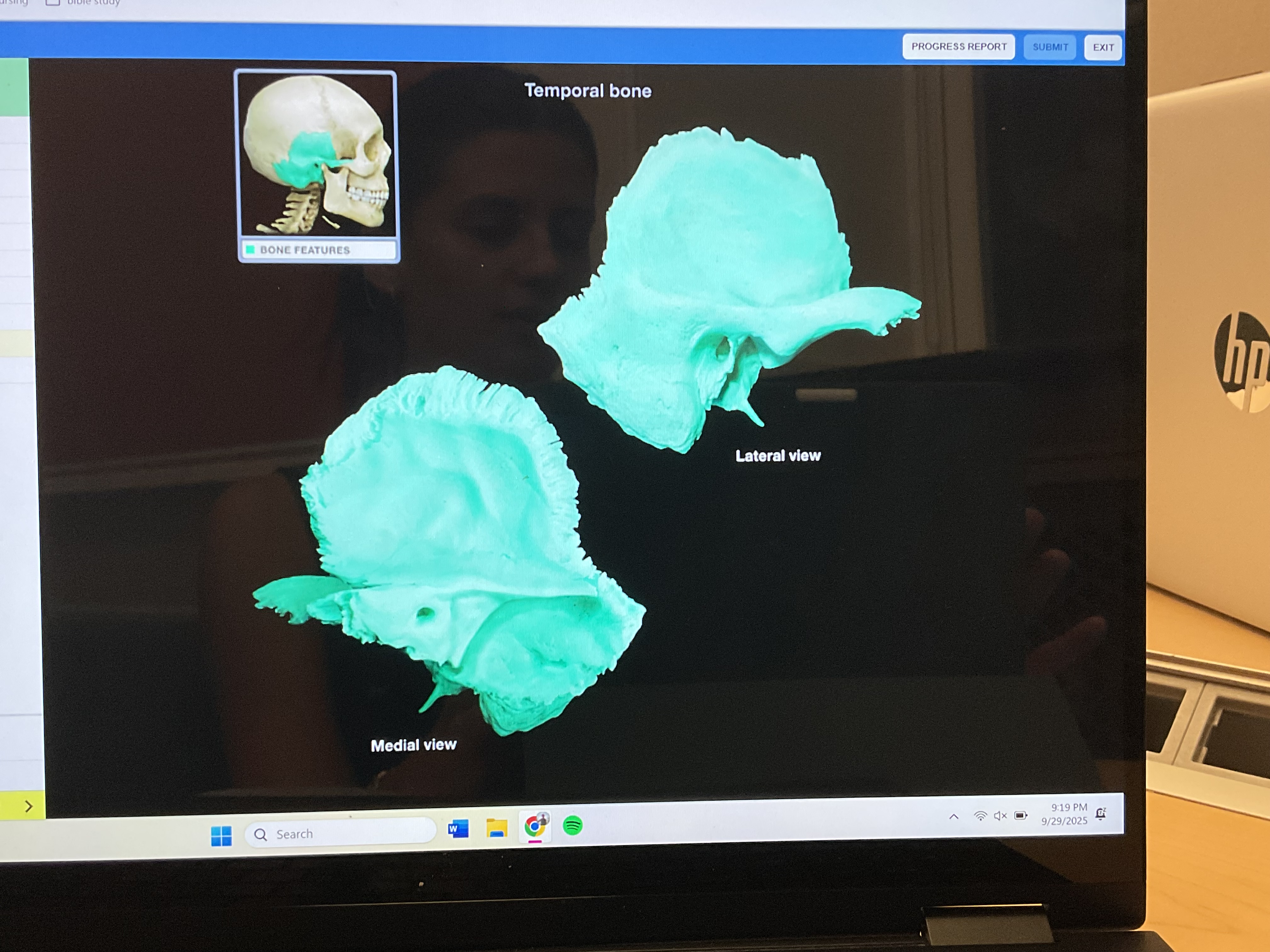 <p>Temporal bone </p>
