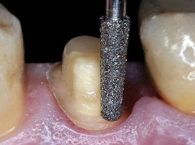 <p>at the gingival</p>