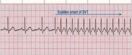 Sudden version / PSVT 