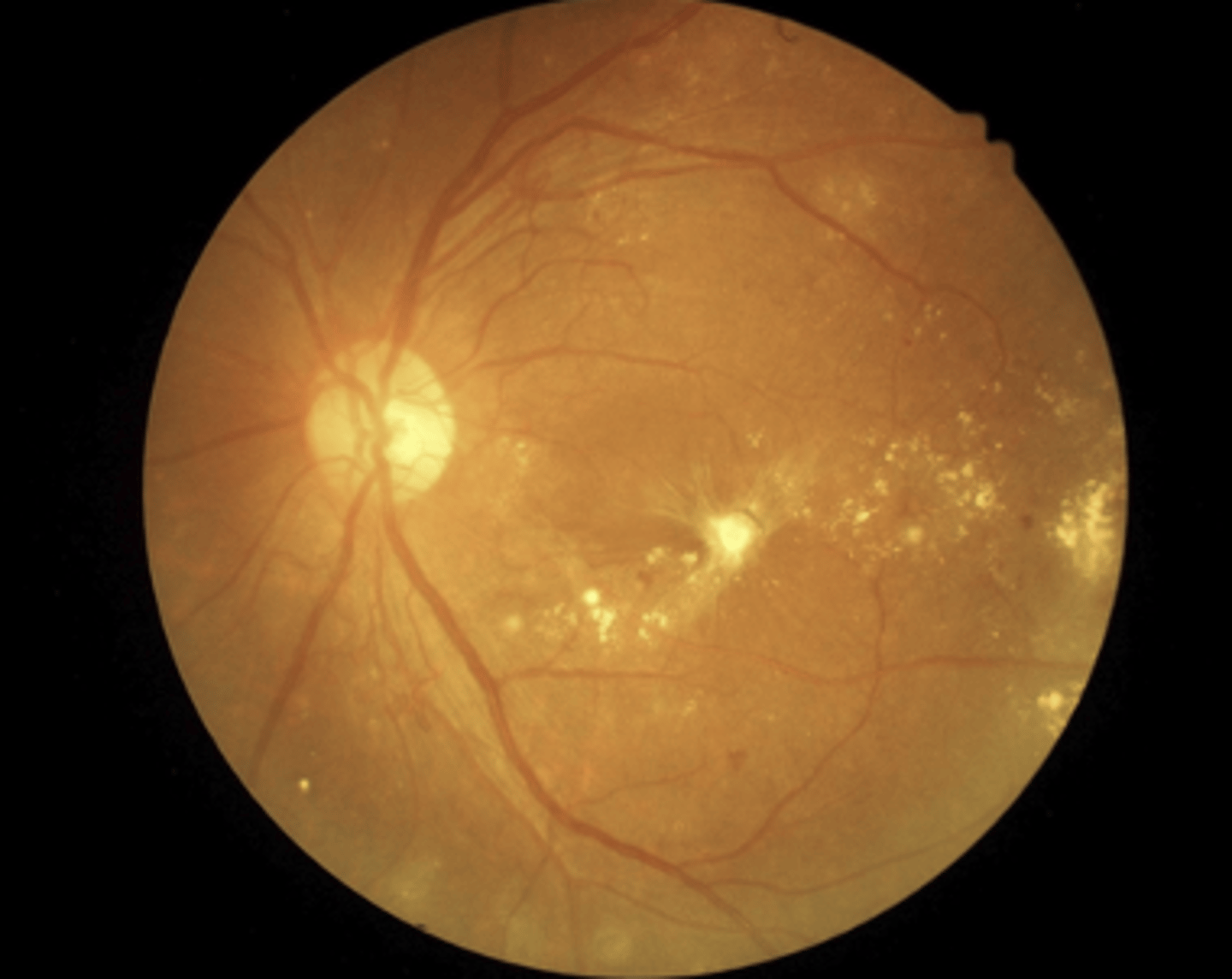<p>cotton wool spots, "dot blot" hemorrhages, hard exudates, neovascularization, and vitreous hemorrhage</p>