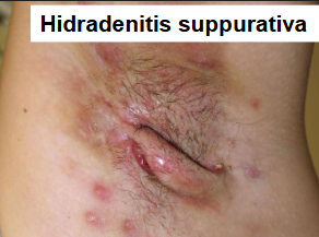 <p>what is hidradenitis suppurativa?</p>