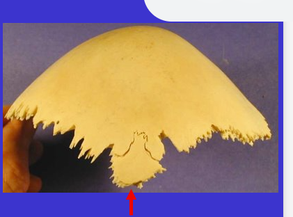 <p>A highly variable little bone</p>