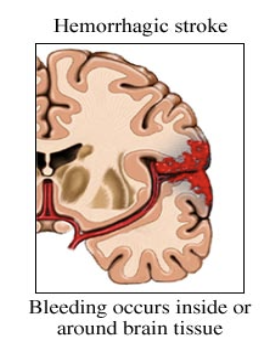 <p>Hemorrhagic stroke</p>