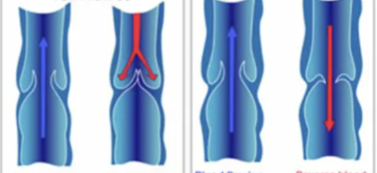 <p>explain varicose vein valves</p>