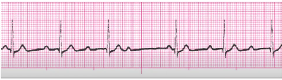 <p>happens with inferior MI (RCA is what is blocked)</p><p>monitor for worse block</p><p>hold meds if the cause</p><p>atropine/pacing for slow rate</p><p>(atropine increase SA node firing (increases P waves, increasing impulses)</p>