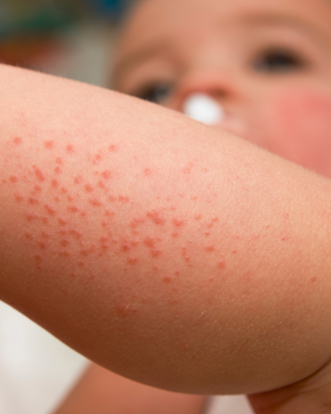 <p>kid brought in during family vacation in florida for 3 days of itchy, burning rash. no known exposures. clear 1-2mm vesicles resembling water droplets that rupture easily on palpation. </p>