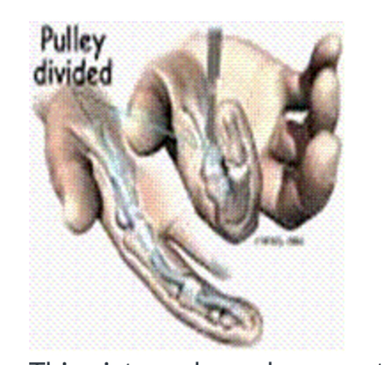 <p>This picture shows hammer toe.</p><p>(T/F)</p>