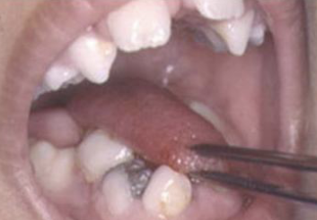 <p>Abnormally small tongue, commonly associated with hypoplasia of the mandible. Oromandibular- limb hypogenesis syndromes</p>