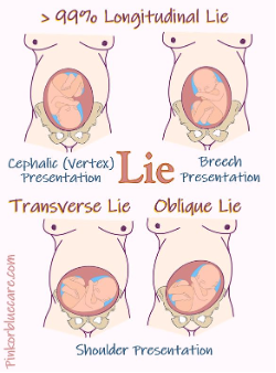 <p>(Usually perform it after 30 weeks)</p><ol><li><p>Continue to monitor the baby’s growth</p></li><li><p>Identify the <mark data-color="yellow" style="background-color: yellow; color: inherit;">location of the placenta</mark></p><ul><li><p>If total placenta (completely cover the os) —> might have many blood lose during delivery</p></li></ul></li><li><p>Identify the <mark data-color="yellow" style="background-color: yellow; color: inherit;">position and presentation</mark> of the foetus</p><ul><li><p>Anterior (head at the os) / Vertex / Cephalic presentation —> natural passage</p></li><li><p>Breech Transverse lie —> recommend C-section</p></li></ul></li></ol><p></p>