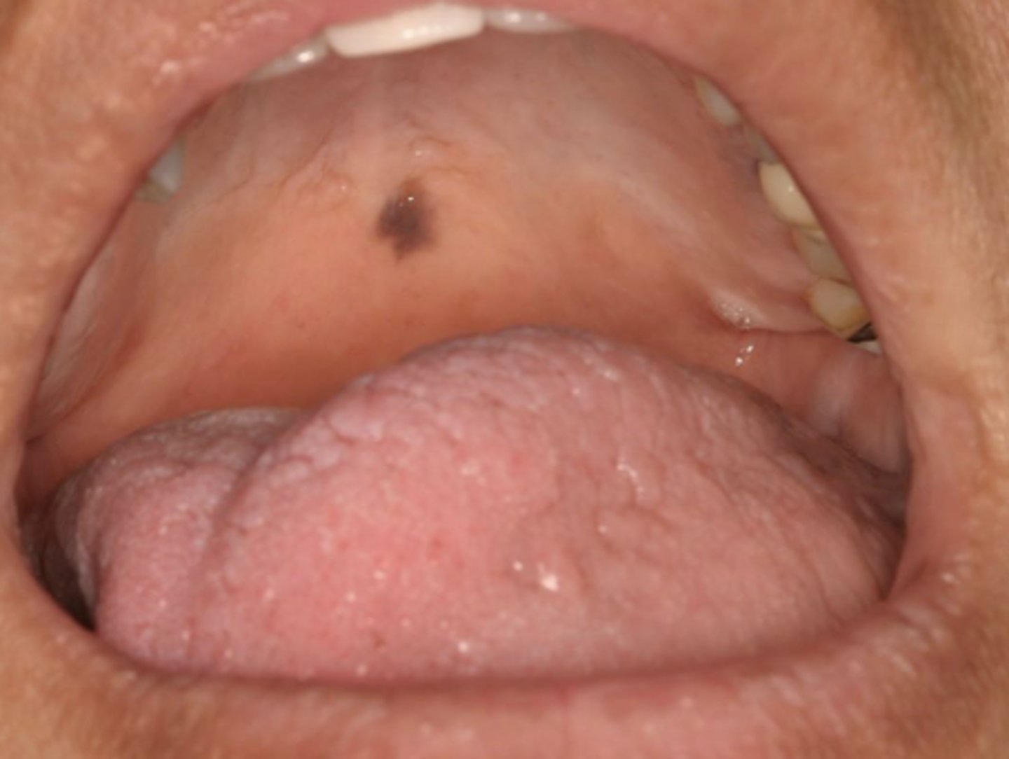 <p>What type of pigmented lesion?</p>