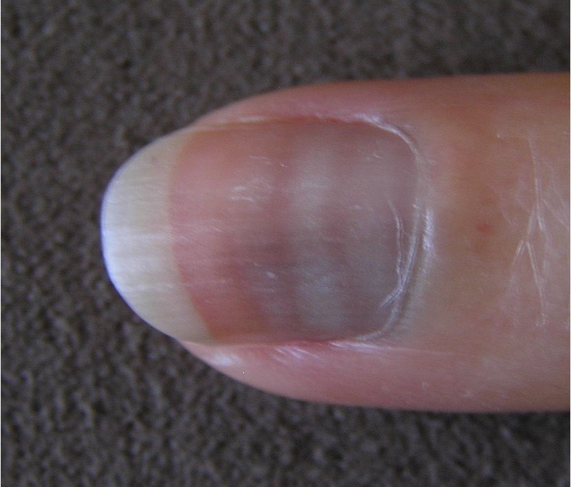 <p>curving transverse white bands on nails</p><p>ex: arsenic poisoning, HF, Hodgkins, CO poisoning</p>