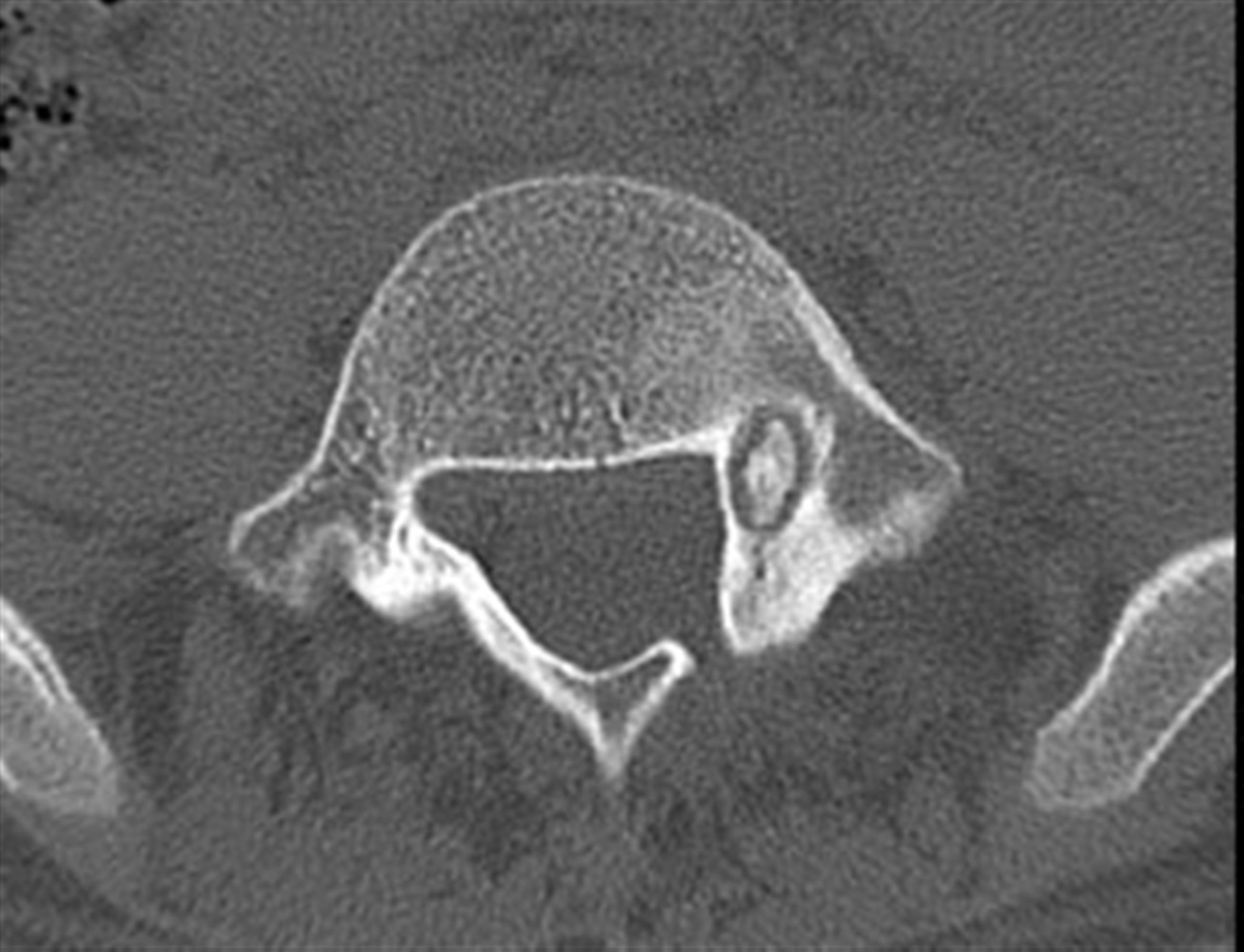 <p>small (&lt;2cm) round lucency with sclerotic margin</p><p>pain worse at night, improves with nsaids</p>